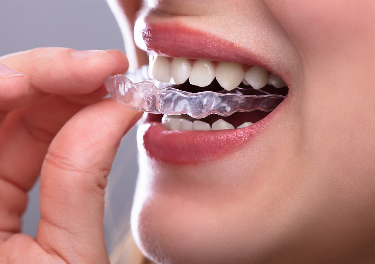 Invisalign Teeth Straightening in Seffner FL Area